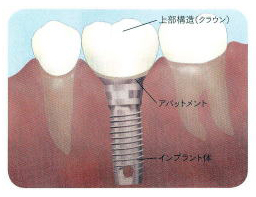 インプラント