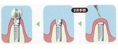 インプラント